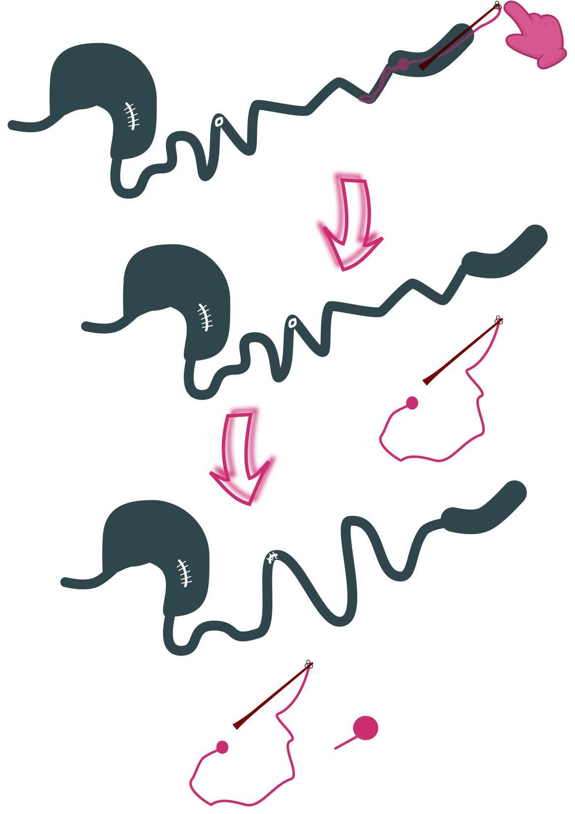 Pictograph of removing feeding tube and LFB